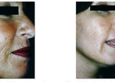 Advanced Cell Stimulation - Aged Skin