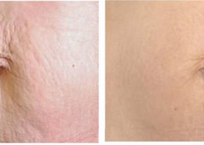Advanced Cell Stimulation - Lax Skin