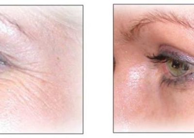 Advanced Cell Stimulation - Crow's Feet