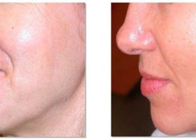 Advanced Cell Stimulation - Improved Skin Texture