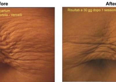 Advanced Cell Stimulation - Lax Skin