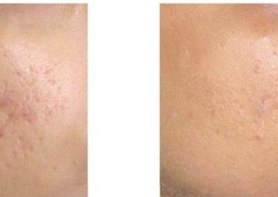 Advanced Cell Stimulation - Acne Scars & Hyperpigmentation