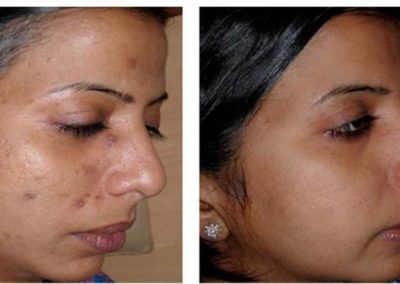 Advanced Cell Stimulation - Severe Acne Scars & Uneven Skin