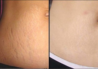 Advanced Cell Stimulation - Stretch Marks