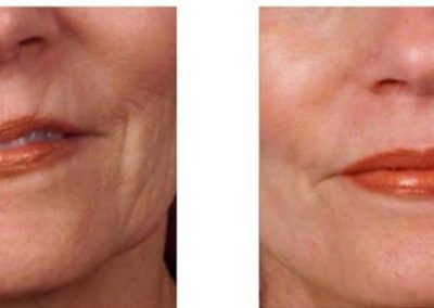 Advanced Cell Stimulation - Wrinkles Around Upper Lips