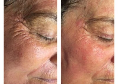 Advanced Cell Stimulation - Wrinkles Around Left Eye