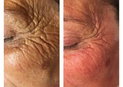 Advanced Cell Stimulation - Wrinkles Around Right Eye