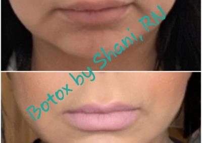 Botox - Before & After
