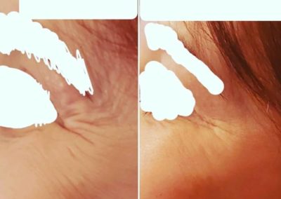 Before & After Botox