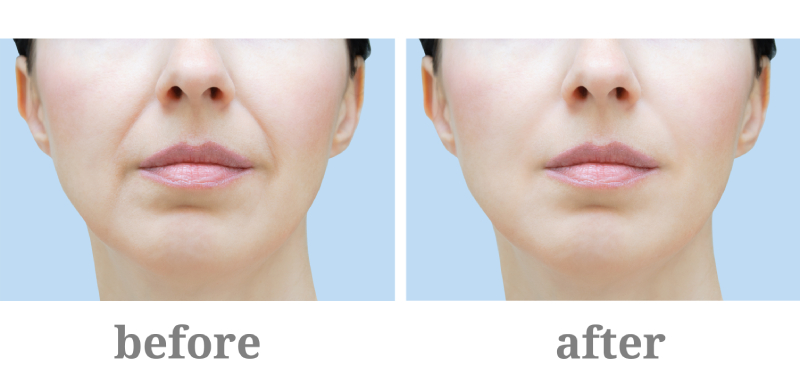 Before and After Fillers (Juvéderm®)