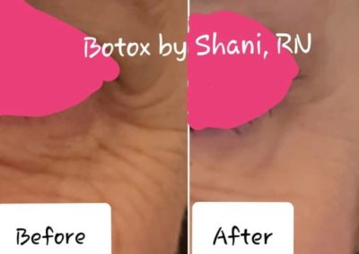 Botox - Eyes - Before & After