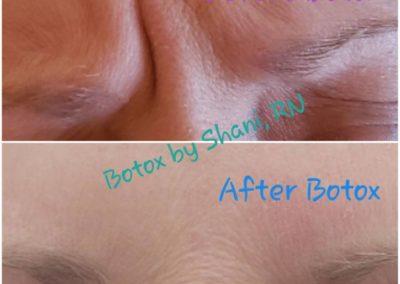 Before & After Botox