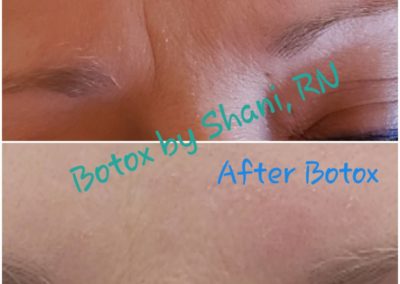 Before & After Botox