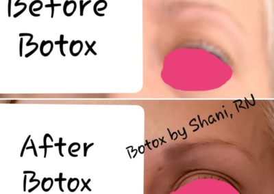 Brow Lift - Before & After