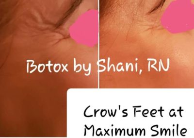 Crow's feet at maximum smile