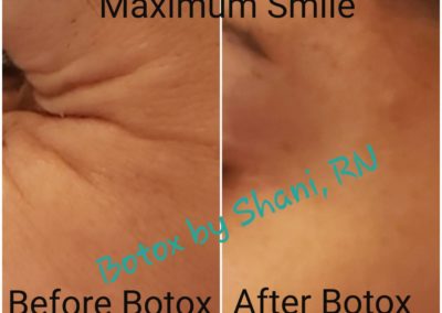 Crow's Feet at Maximum Smile