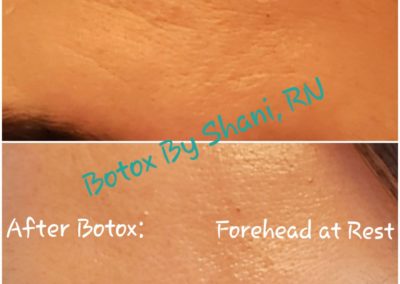 Forehead at Rest - Before & After