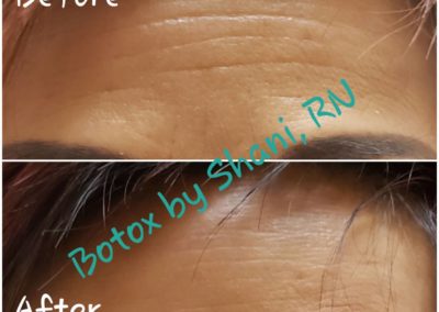 Forehead at Rest - Before & After