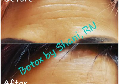 Forehead at Rest - Before & After