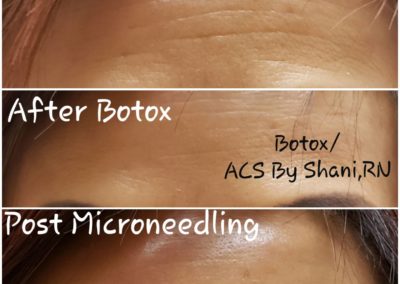 Before & After Botox and Microneedling
