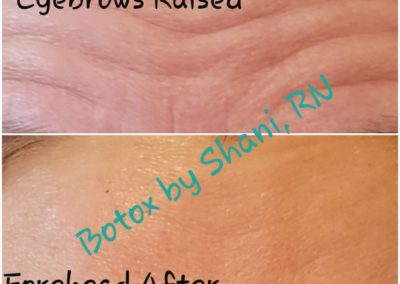 Forehead Eyebrows Raised - Before & After