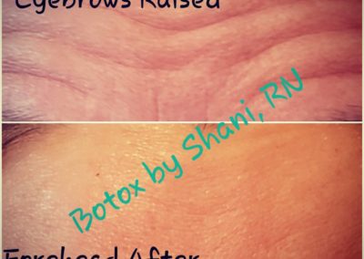 Eyebrows Raised - Before & After
