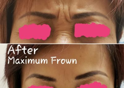 Maximum Smile - Before & After