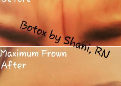 Maximum Frown - Before & After