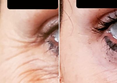 Before & After - Botox