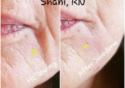 Marionettes, HA Filler - Before & After