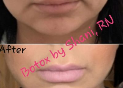 Masseter Reduction - Before & After