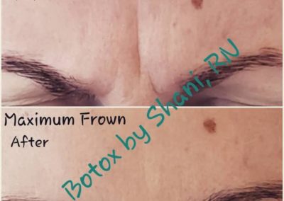 Maximum Frown - Before & After