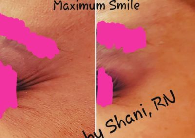 Maximum Smile - Before & After