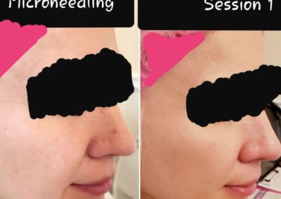 Microneedling - Before & After