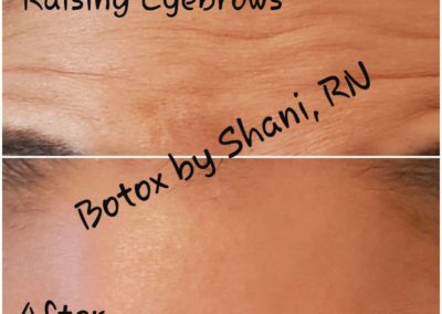 Raising Eyebrows - Before & After
