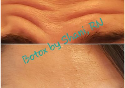 Raising Eyebrows - Before & After Botox